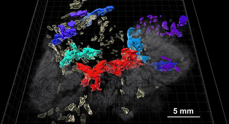 Mapas em 3D inéditos do câncer colorretal podem ajudar no tratamento da doença no futuro